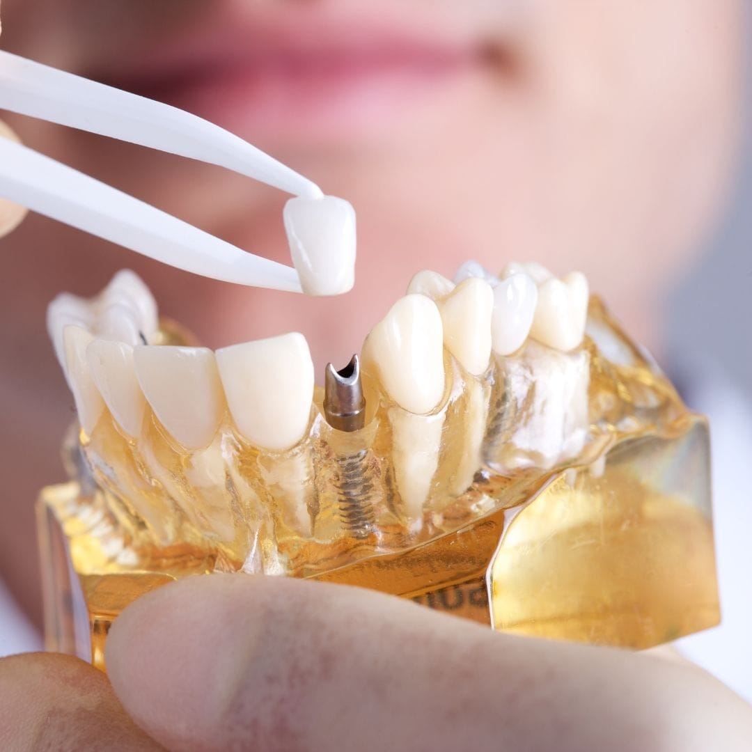 Implantes Dentales