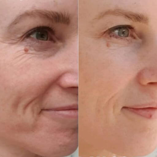 Truvy collagen before and after 8 weeks results