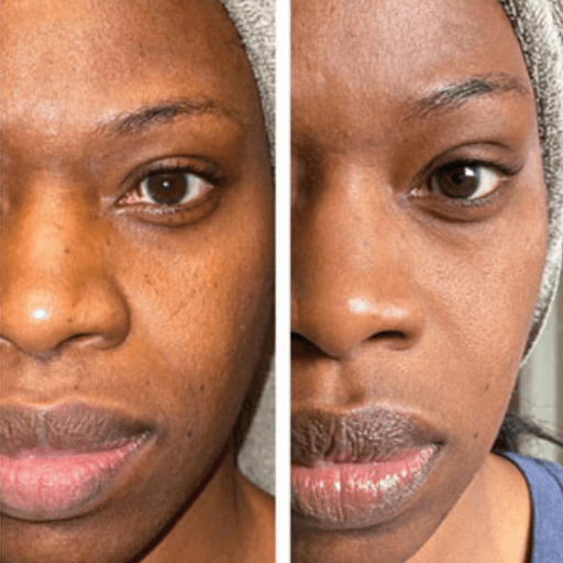 Truvy collagen before and after 5 weeks results