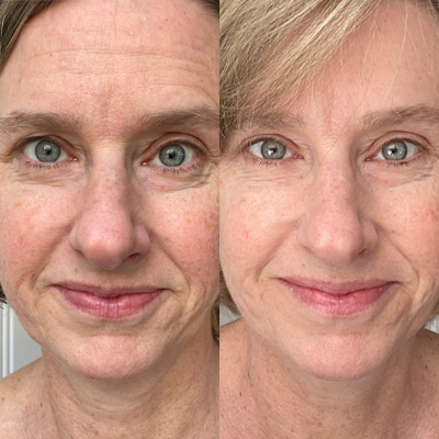 Truvy collagen before and after 5 weeks results