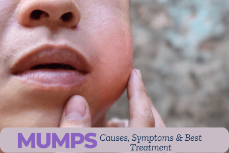 Mumps – Causes, Symptoms, Treatment, and Prevention Guide