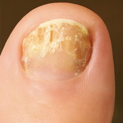 Infected nail with fungus