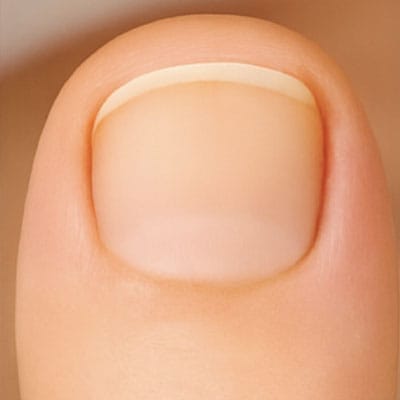 Healthy nail after treatment