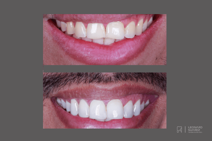 Diseño de Sonrisa Santa Marta