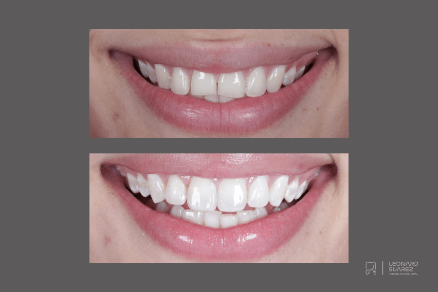 Diseño de Sonrisa Santa Marta