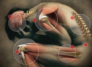 Comment soulager la fibromyalgie