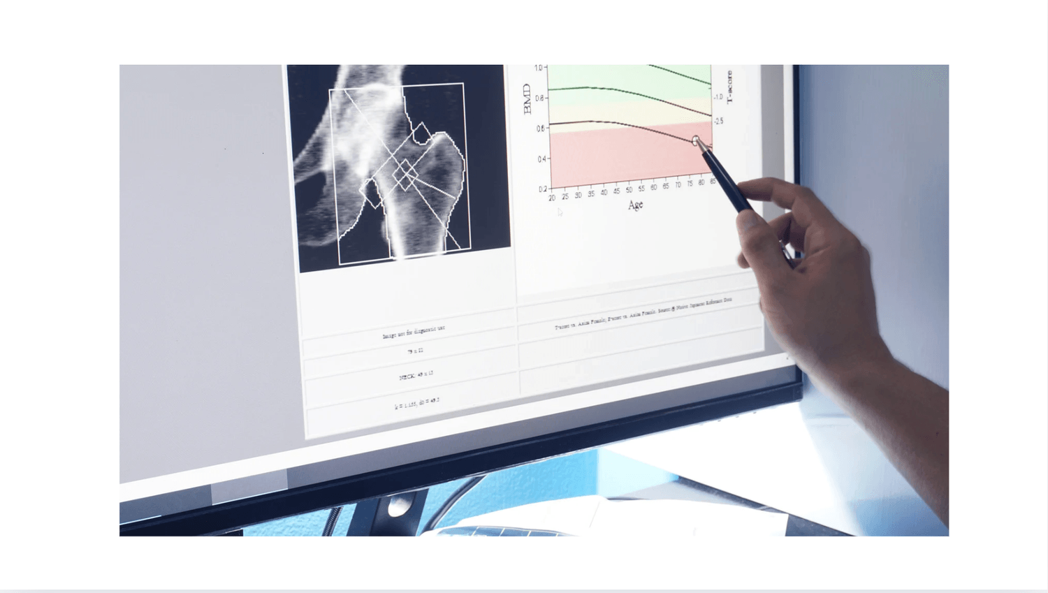 骨粗鬆症のリスク