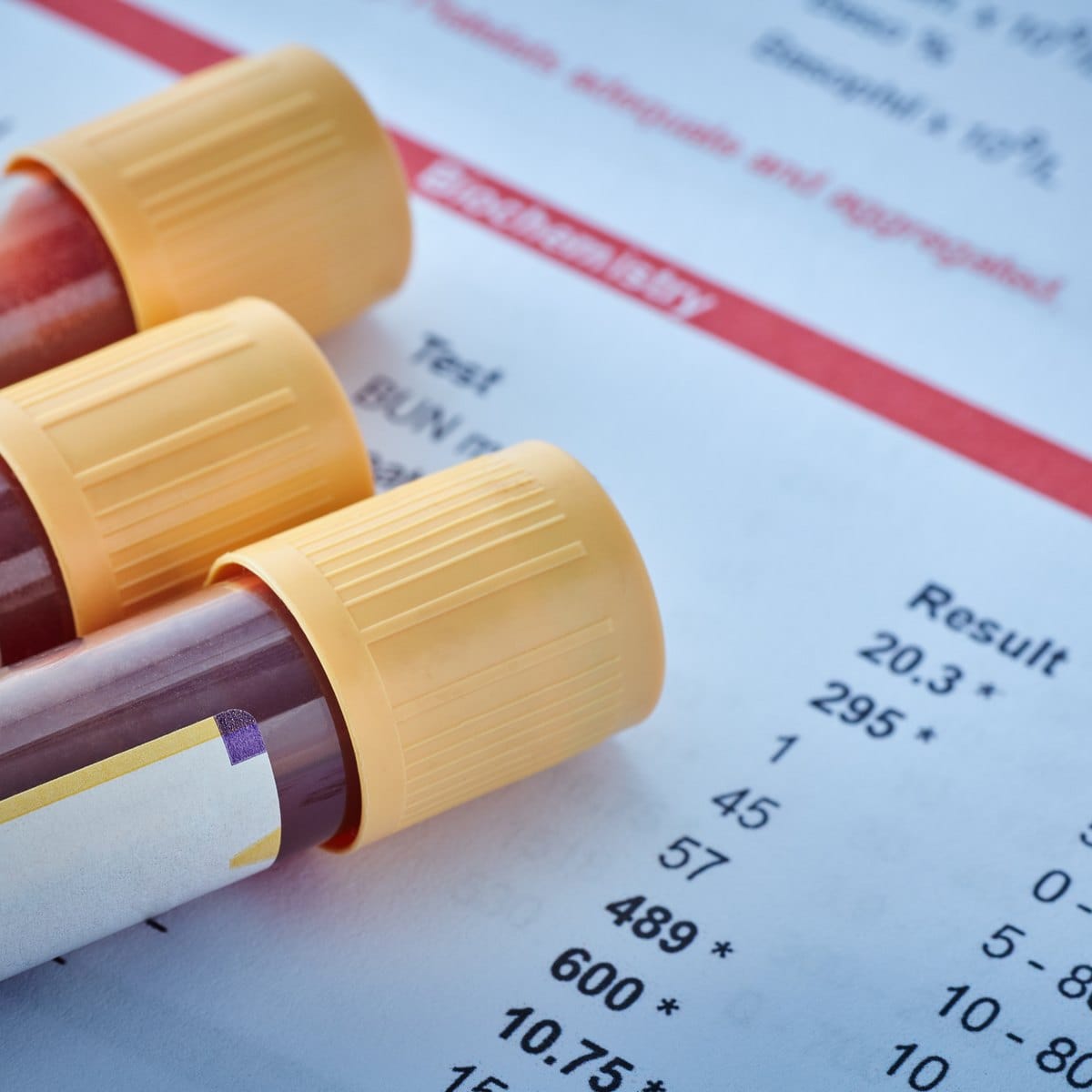 Blood collection tubes resting on a lab results printout