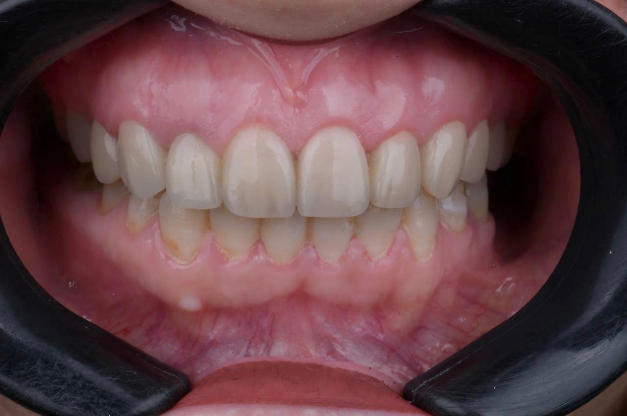تجميل الأسنان الأمامية