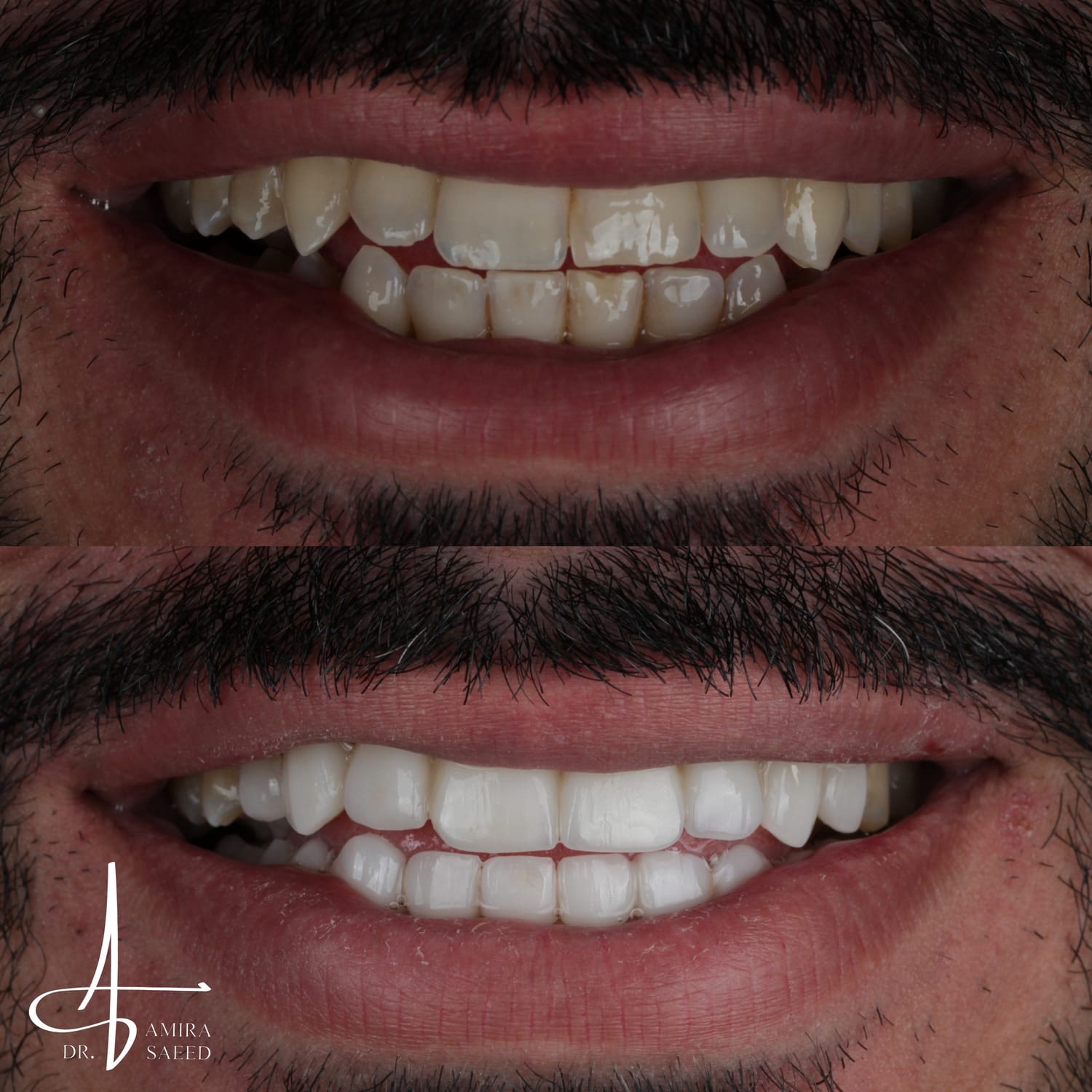 Before and after smile case