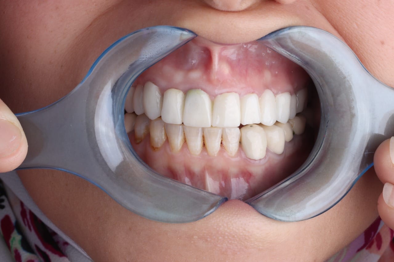 After dental case
