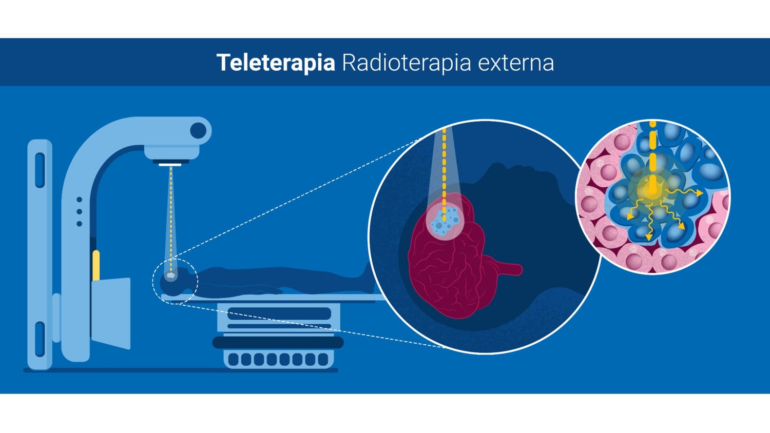 Interacción de la radiación con el tejido en radioterapia