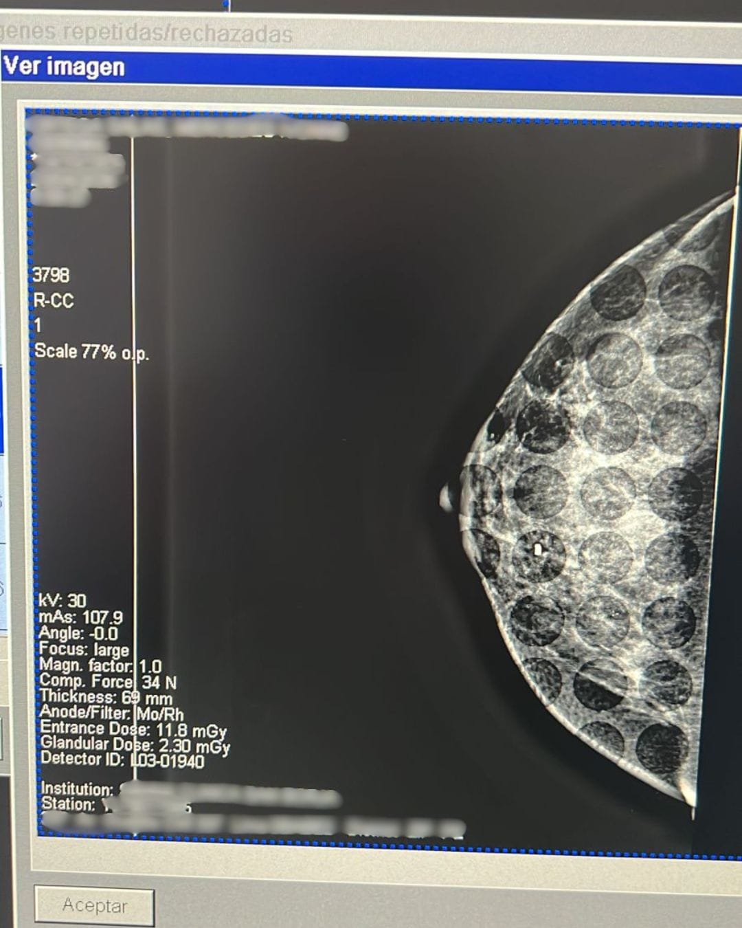 mamografia-con-arpon-imagen sobreexpuesta