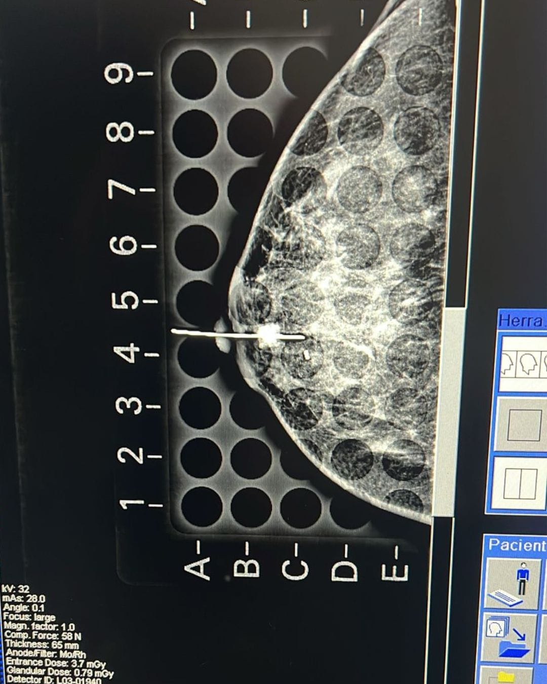 mamografia-imagen correcta