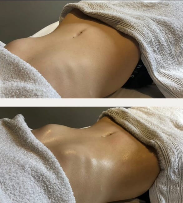 Laura B. en séance de drainage lymphatique