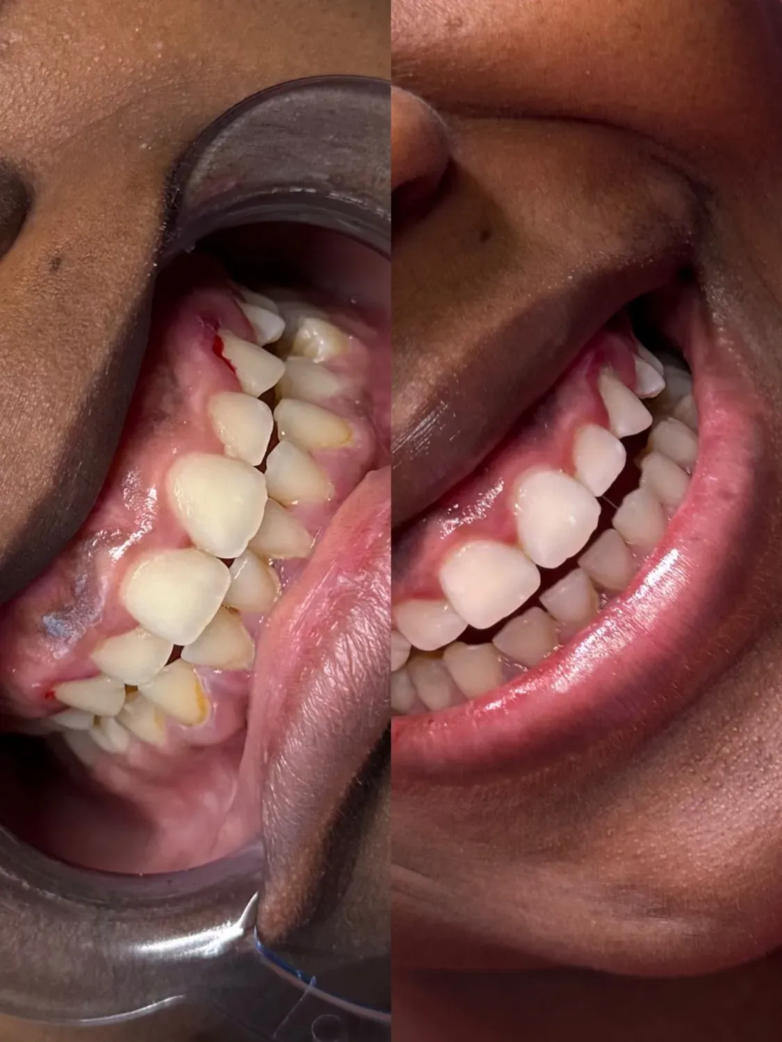 Avant / après blanchiment dentaire – cliente souriante avec dents visiblement plus blanches après le soin