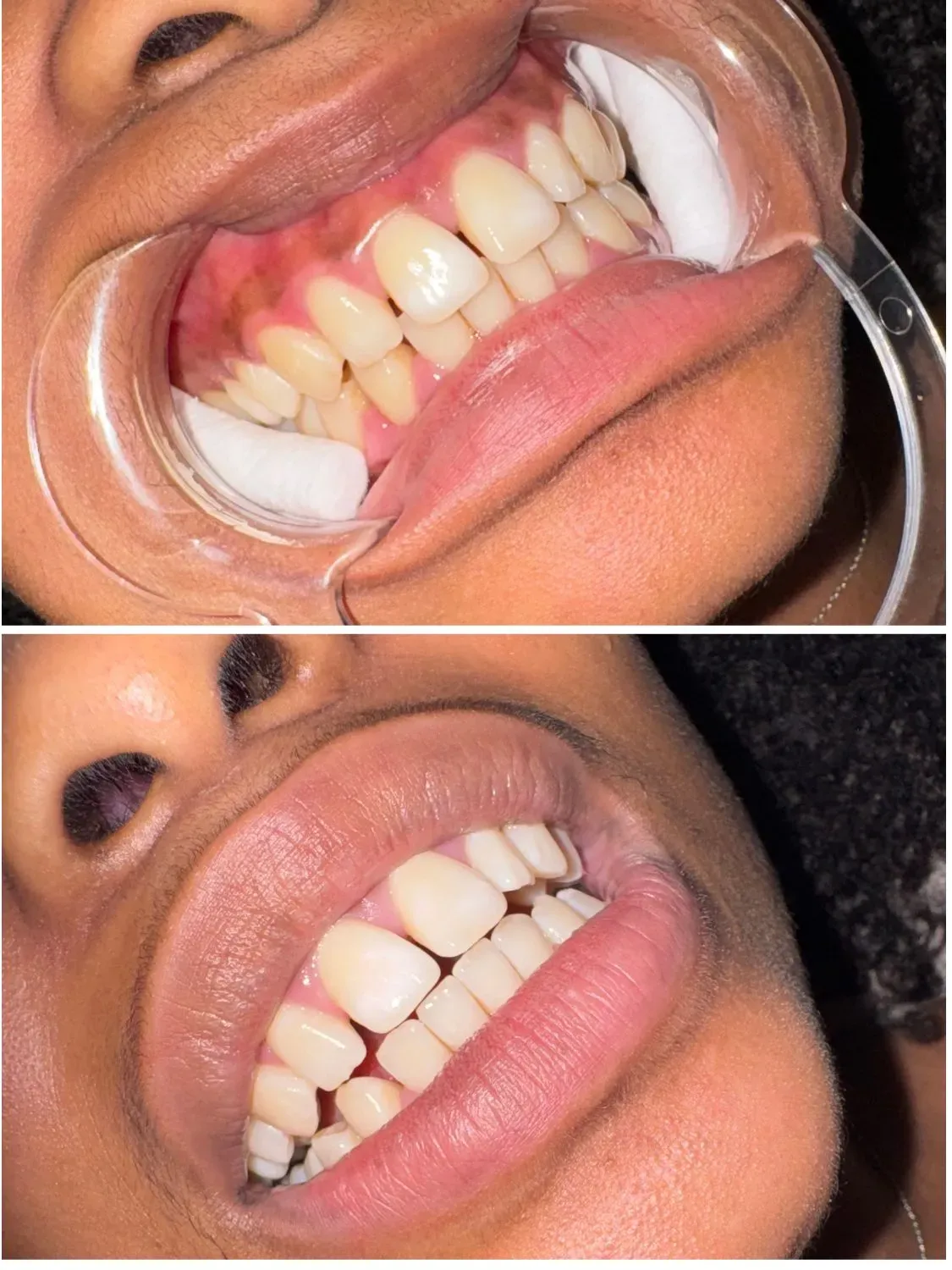 Résultat avant après d’un blanchiment dentaire professionnel sur une cliente souriante aux dents plus éclatantes