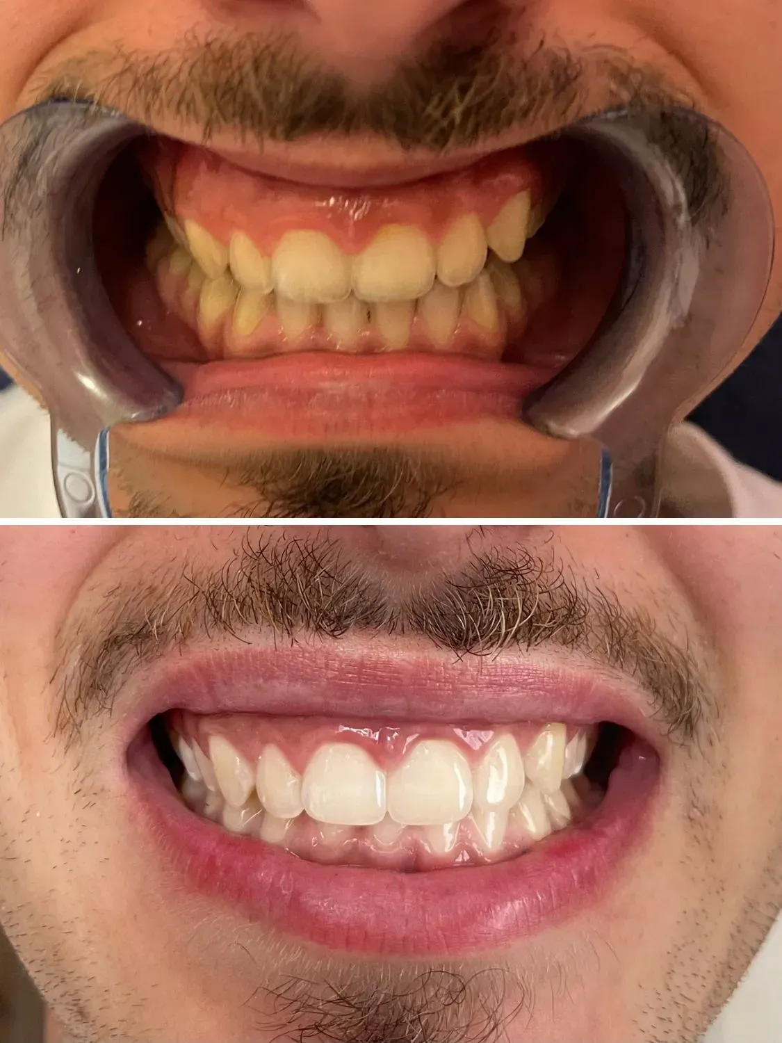 Photo avant/après d'un client pour montrer ses dents plus blanches 