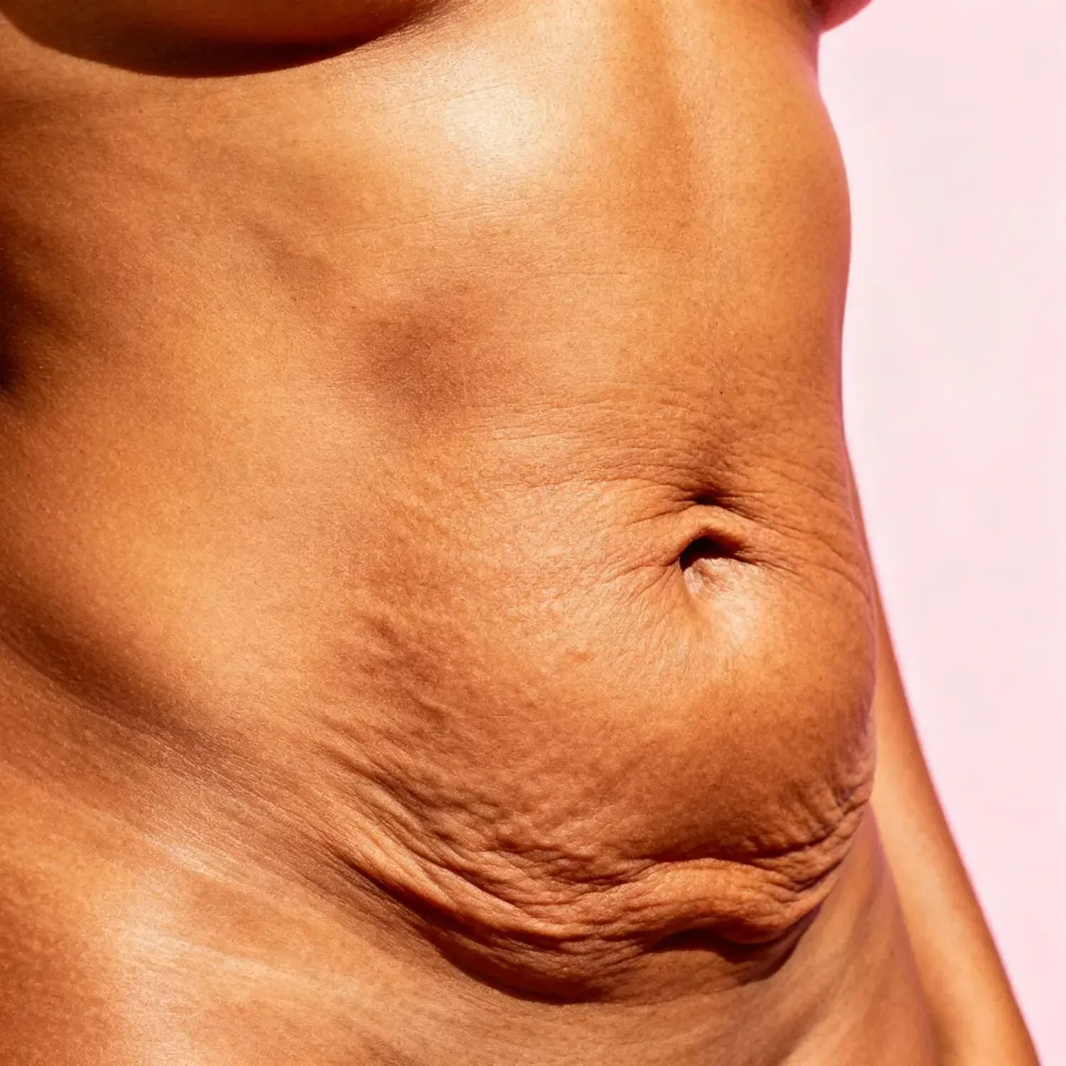 Pele com flacidez antes do tratamento.