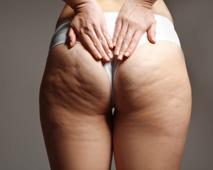 Região dos glúteos com flacidez.
