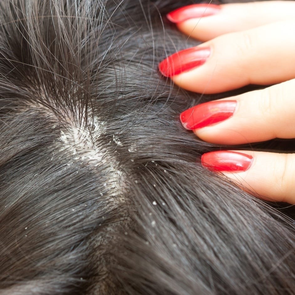 Couro cabeludo com caspa (dermatite seborreica).