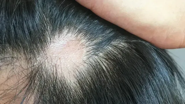 Mão segurando uma mecha de cabelo, simbolizando queda capilar.