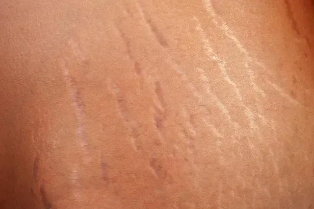 Abdômen com estrias.