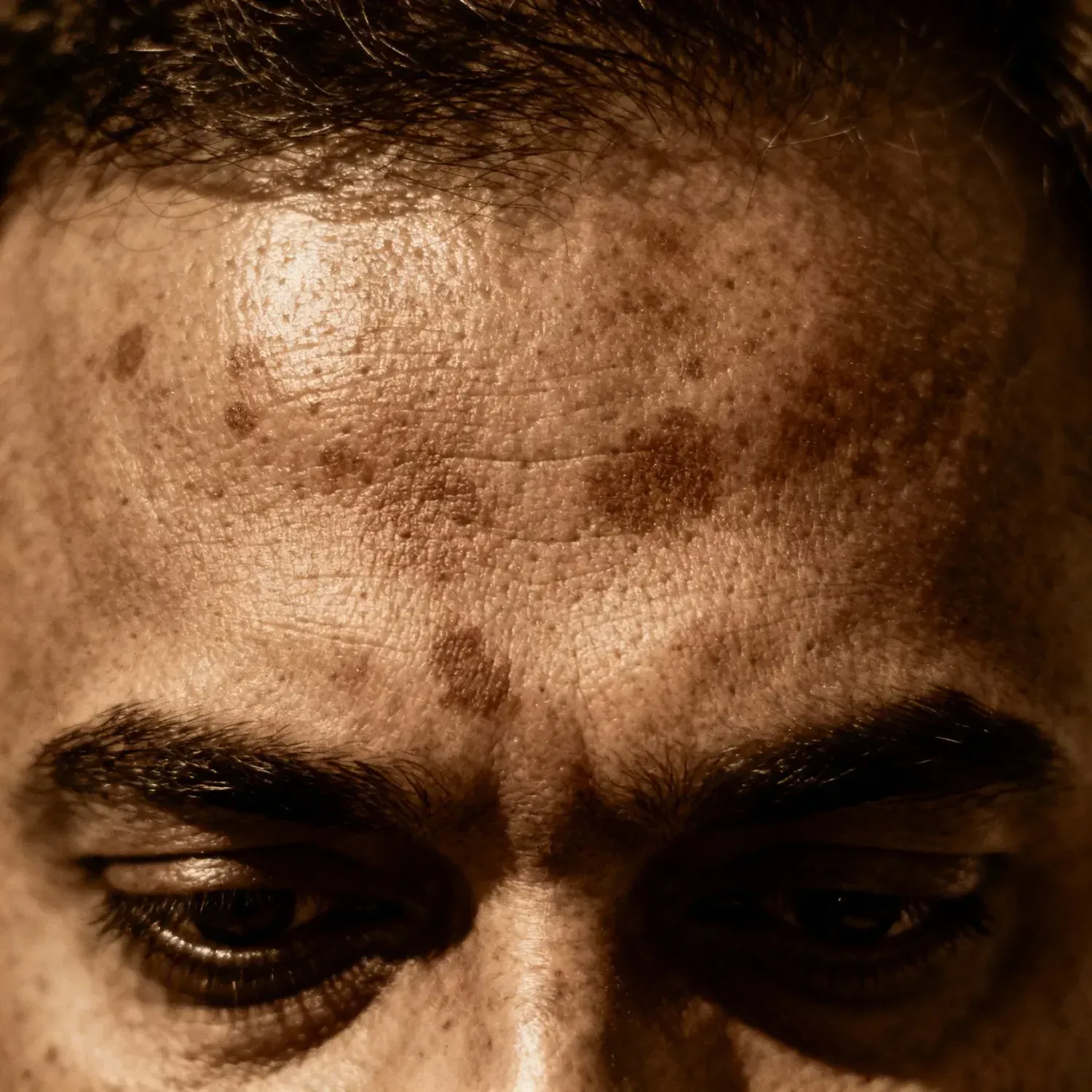 Close de uma pele com manchas de melasma.