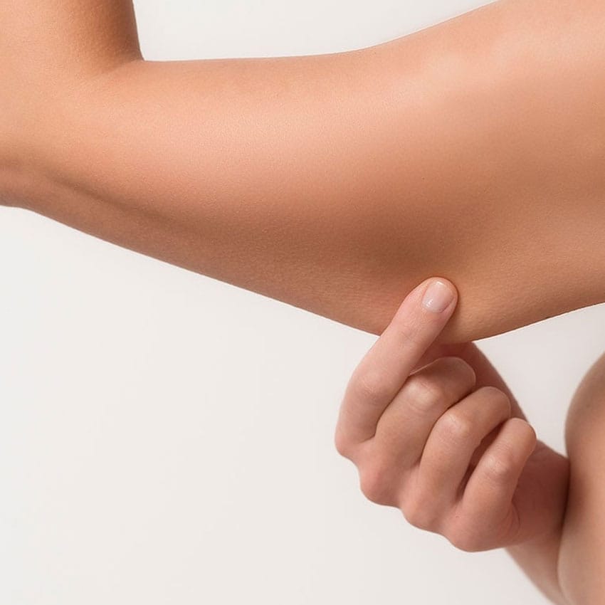 Braço de mulher com sinais de flacidez na pele.
