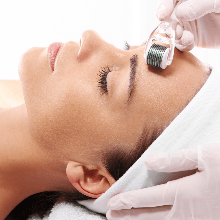 Procedimento de microagulhamento sendo realizado no rosto.