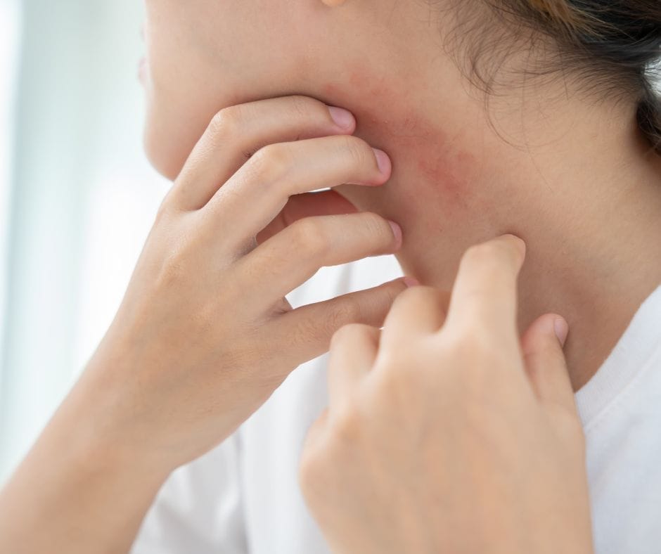 frau mit hektischen roten Flecken am Hals und Juckreiz im Gesicht als Folge von Innerer Unruhe und Nervosität. Ursachen können die Wechseljahre, Mangel an Progesteron oder zuviel Histamin sein