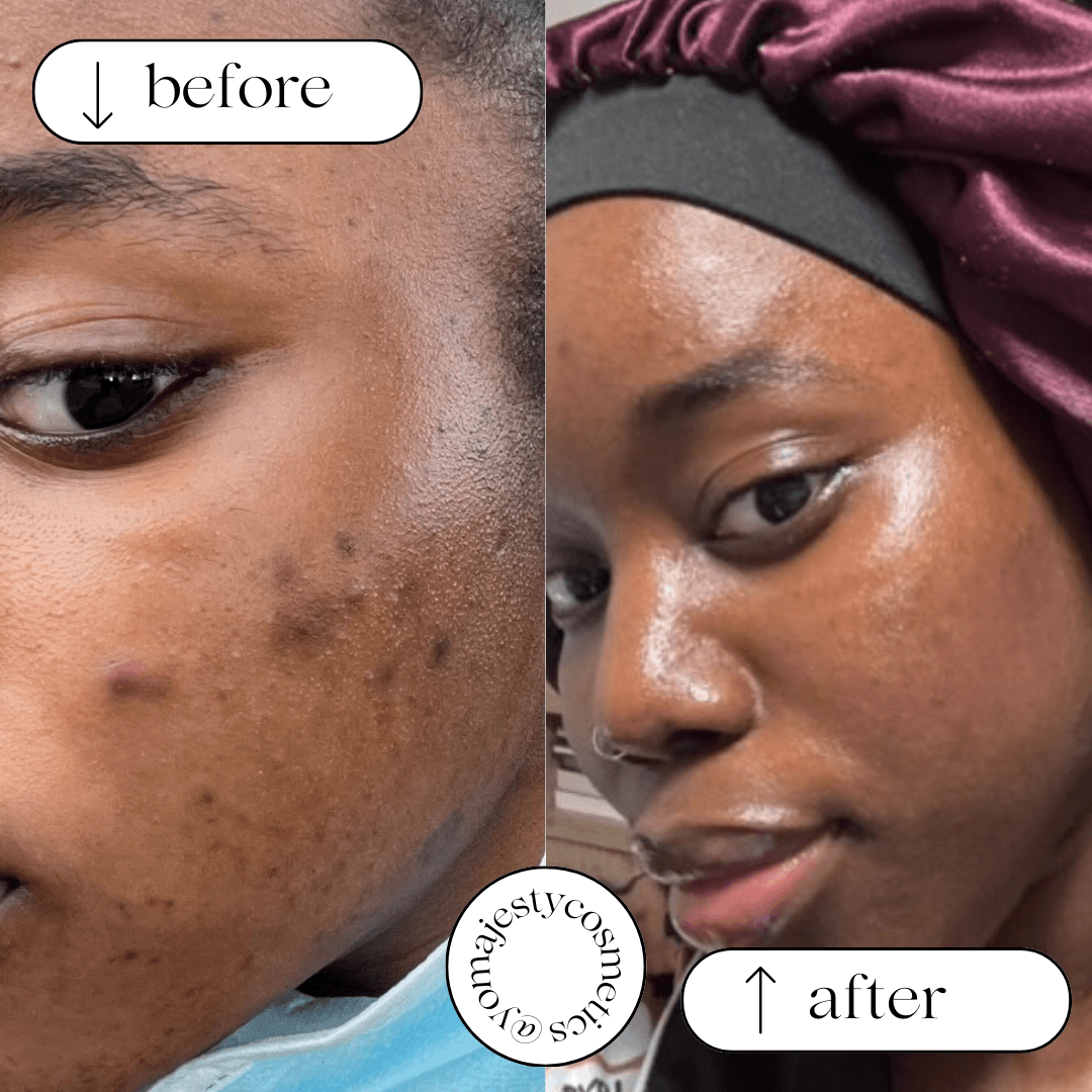 before and after turmeric soap results