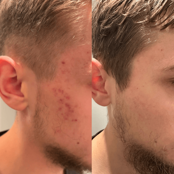 turmeric soap results for dark spots