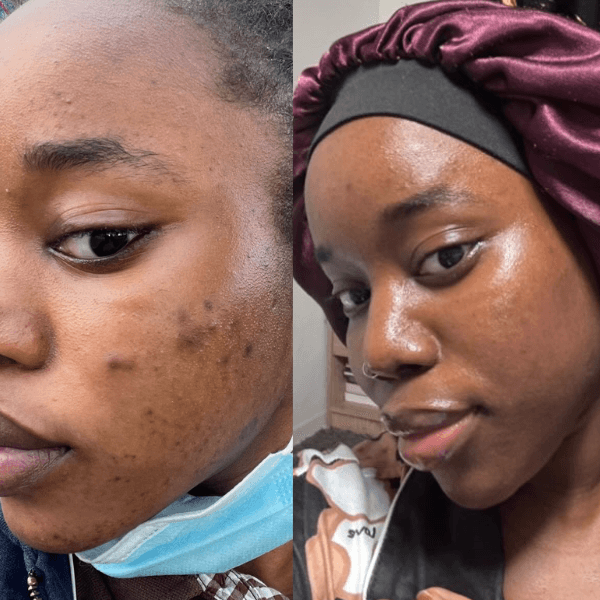 before and after turmeric soap results