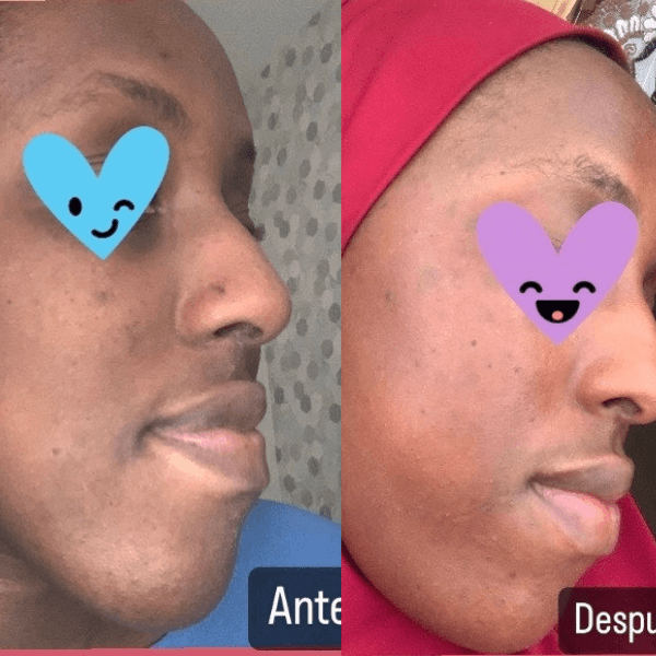 skin brightening results before and after