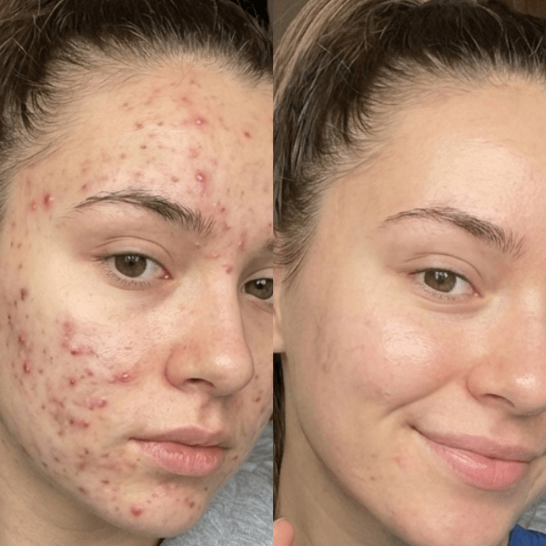 acne scars improvement natural skincare