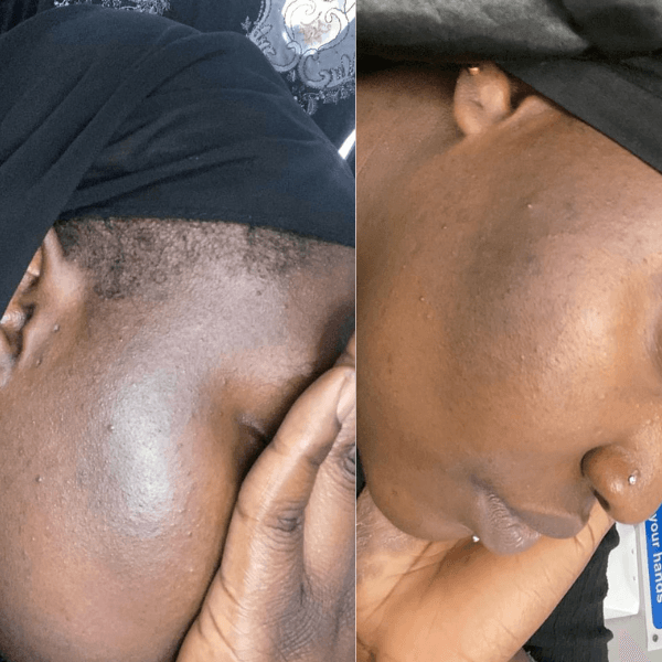 hyperpigmentation before and after natural skincare