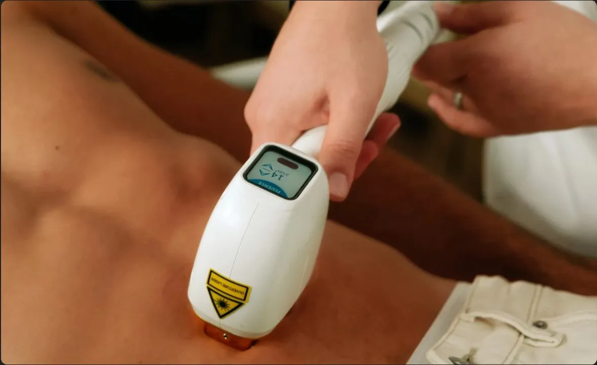 Épilation laser homme du ventre avec laser diode