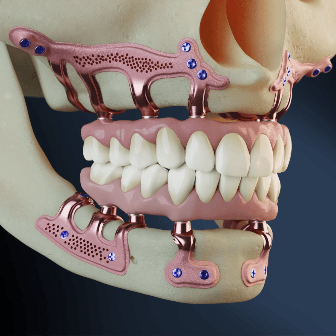 Subperiosteal implant lateral view