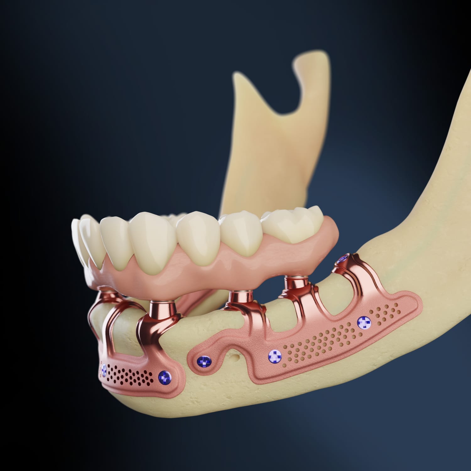 Mandibular subperiosteal implant with bridge