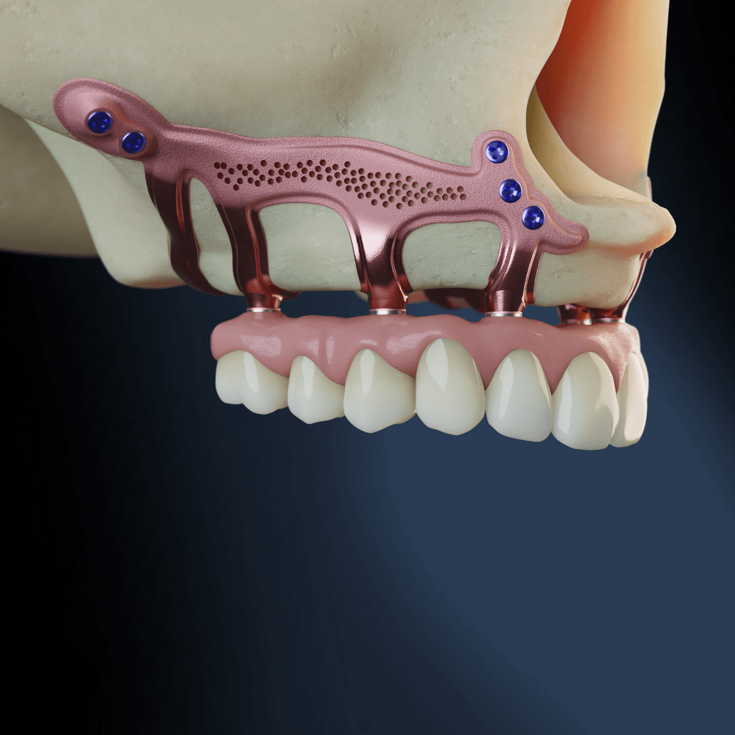 Maxillary subperiosteal implant with bridge