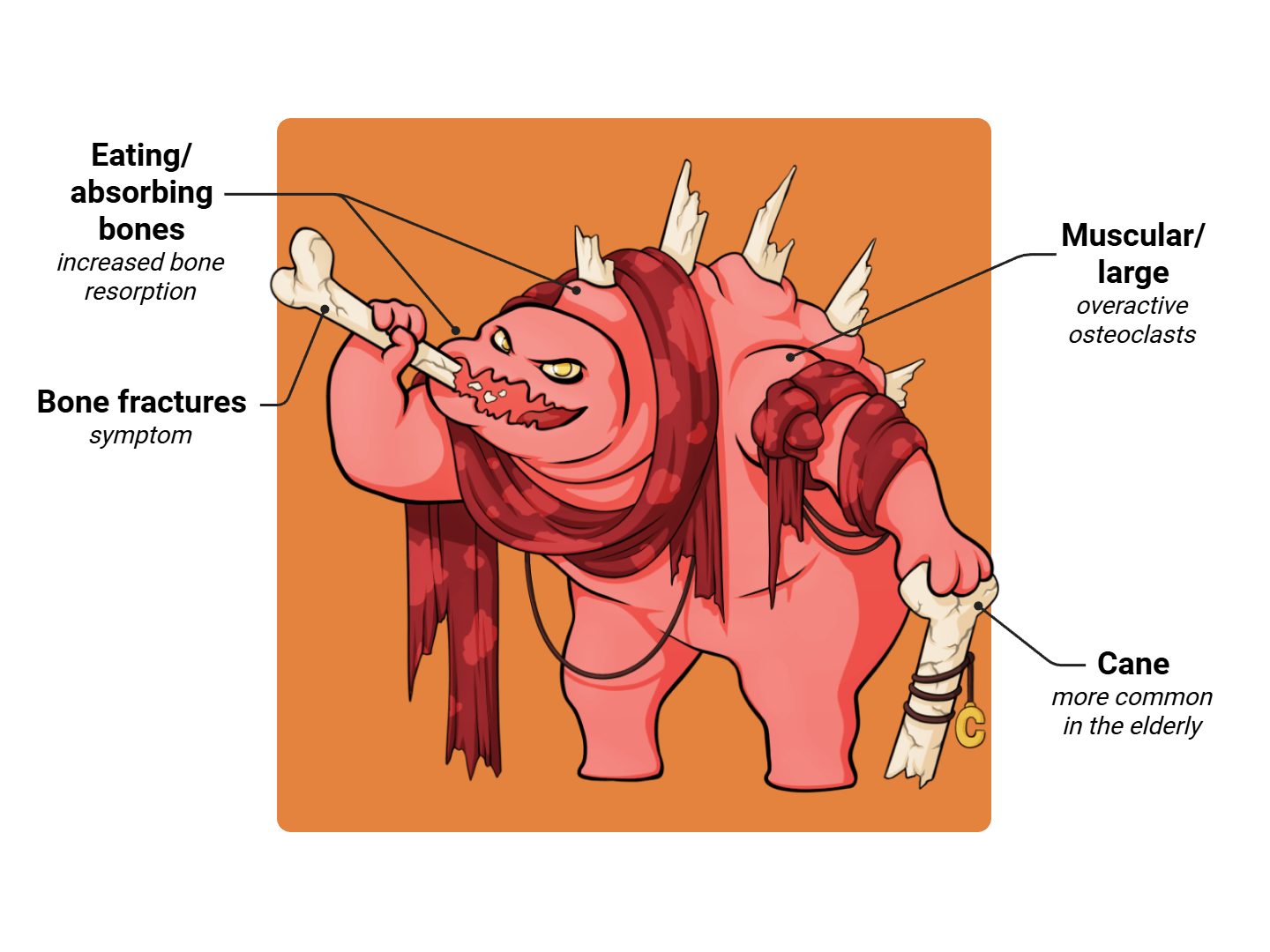 Osteoporosis Medimon infographic with labeled medical features and mnemonic annotations.