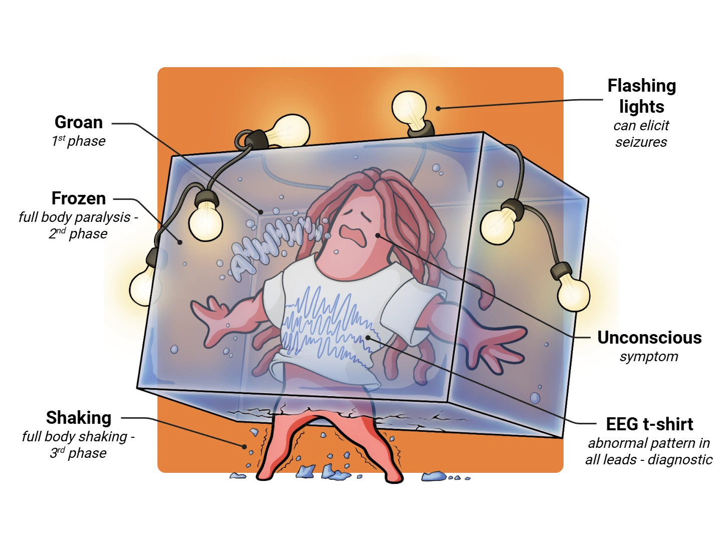 Epilepsy Medimon infographic with labeled medical features and mnemonic annotations.