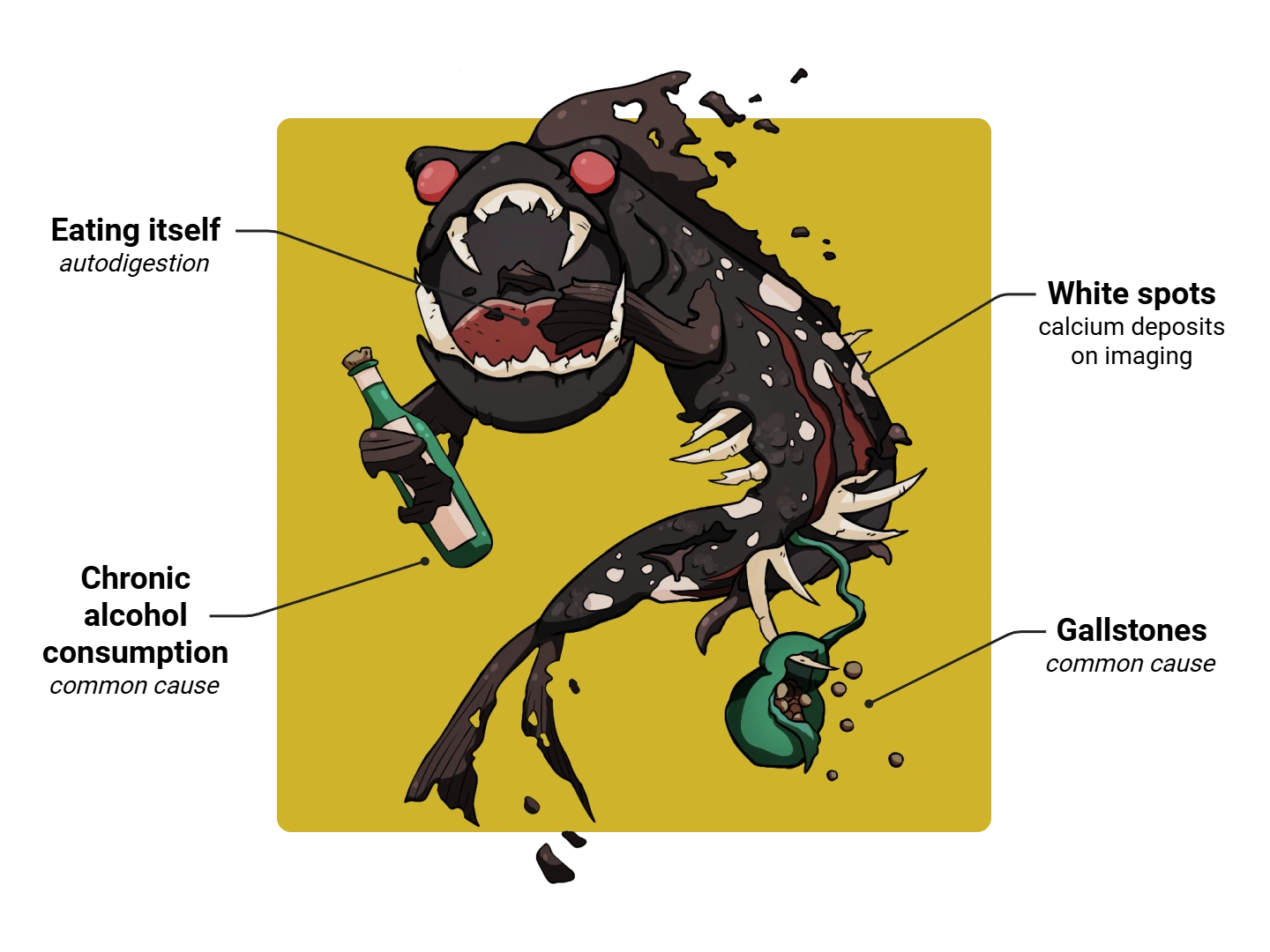 Pancreatitis Medimon infographic with labeled medical features and mnemonic annotations.