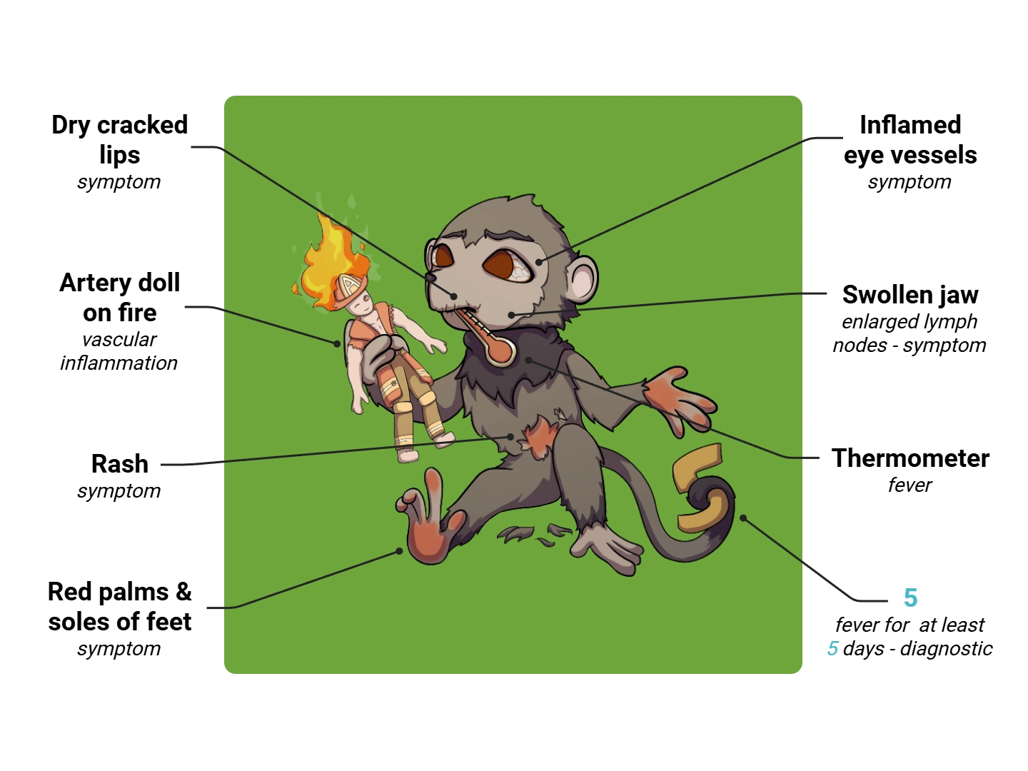 Kawasaki Disease Medimon infographic with labeled medical features and mnemonic annotations.