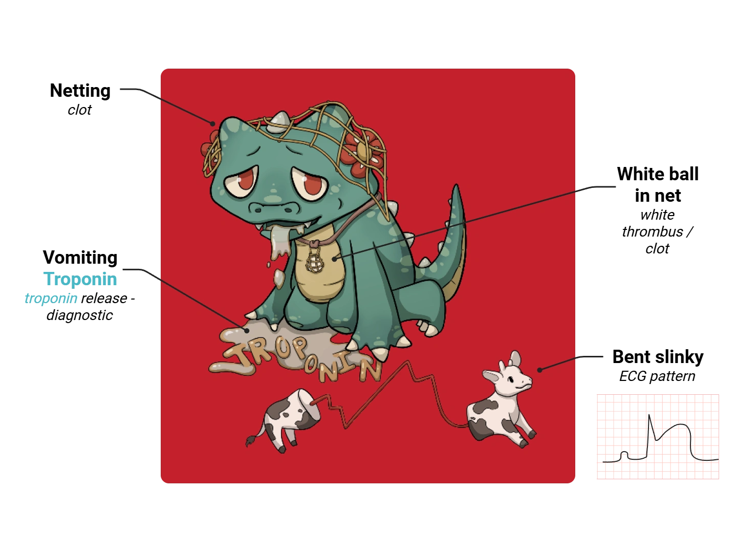 Heart Attack Medimon infographic with labeled medical features and mnemonic annotations.