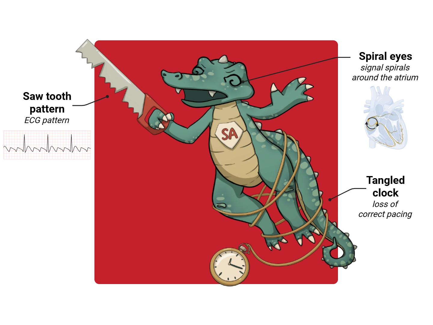 Atrial Flutter Medimon infographic with labeled medical features and mnemonic annotations.