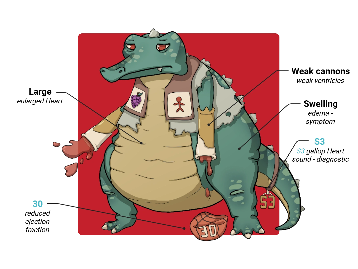 Systolic Heart Failure Medimon infographic with labeled medical features and mnemonic annotations.