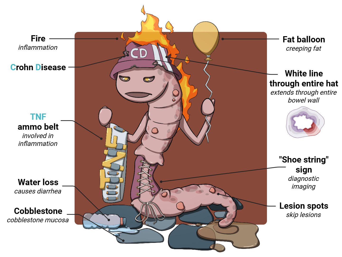 Crohn's Disease Medimon infographic with labeled medical features and mnemonic annotations.