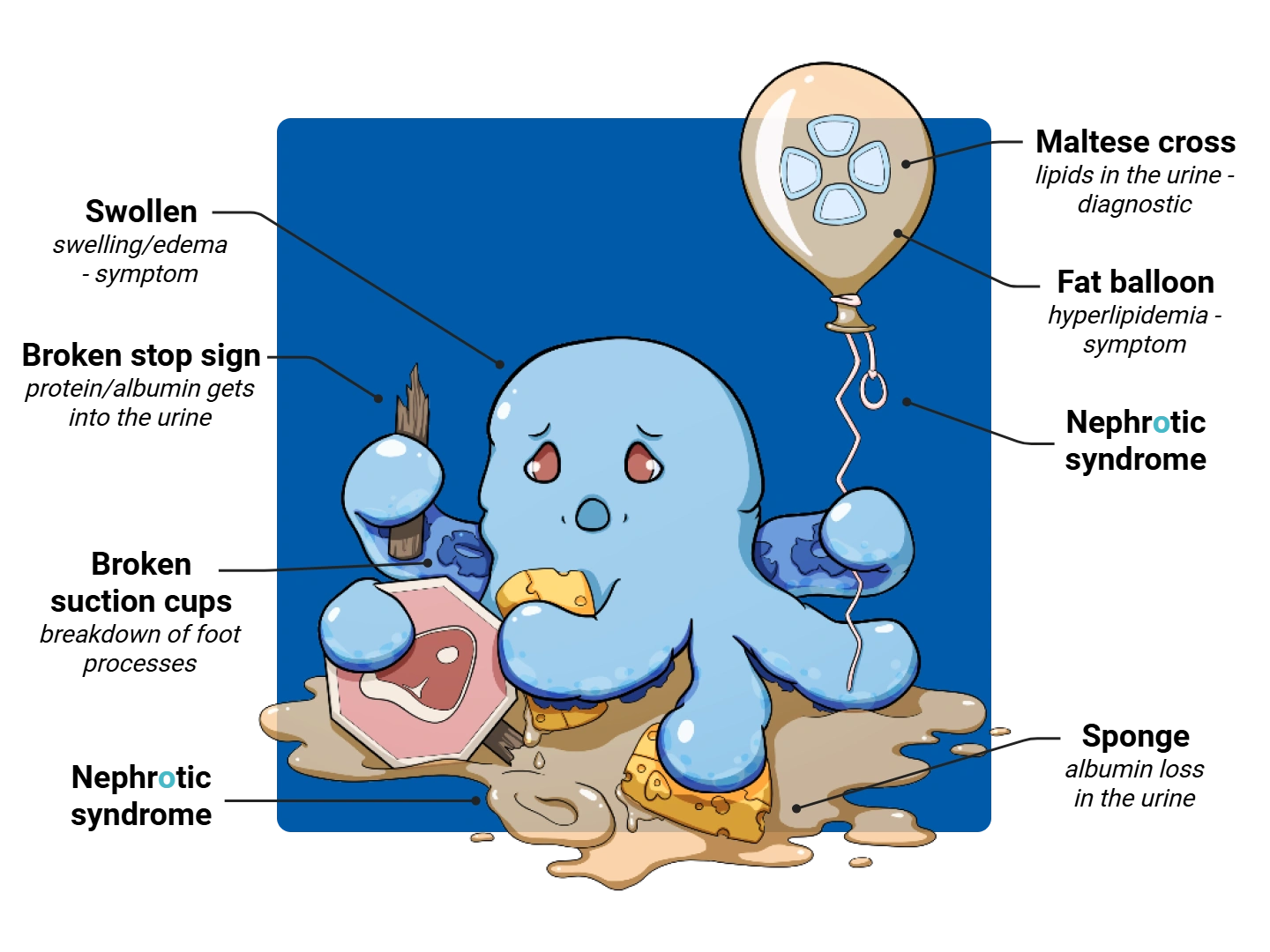 Nephrotic Syndrome Medimon infographic with labeled medical features and mnemonic annotations.